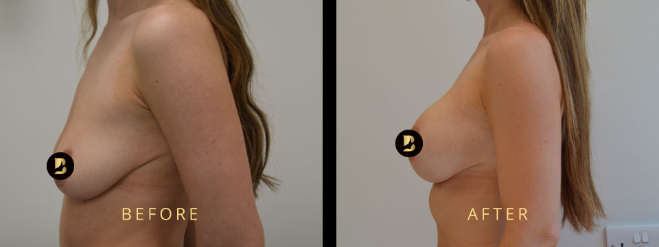 breast augmentation before after