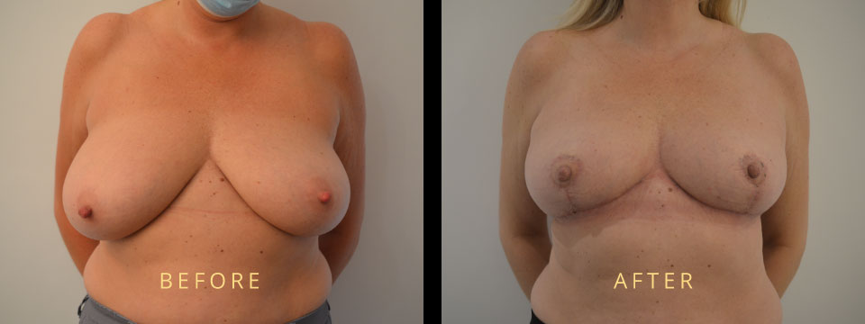 breast reduction before after