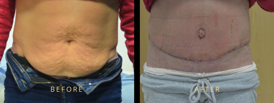 tummy tuck before after