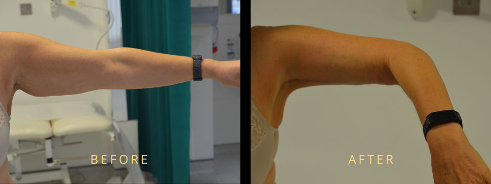 arm reduction before after