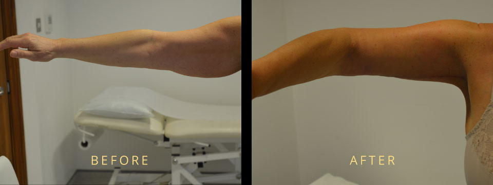 arm reduction before after