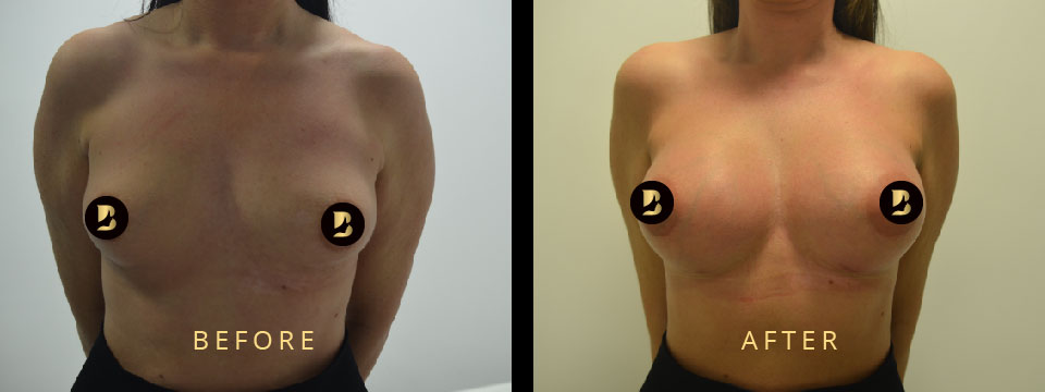 breast augmentation before after