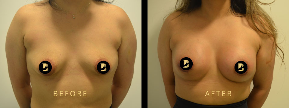 breast correction before after
