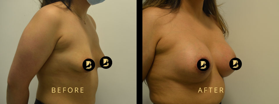 breast correction before after