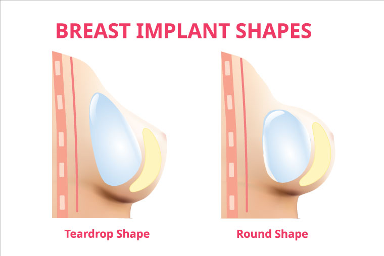 Different Shapes of Breast Implants - Breast & Body Clinic