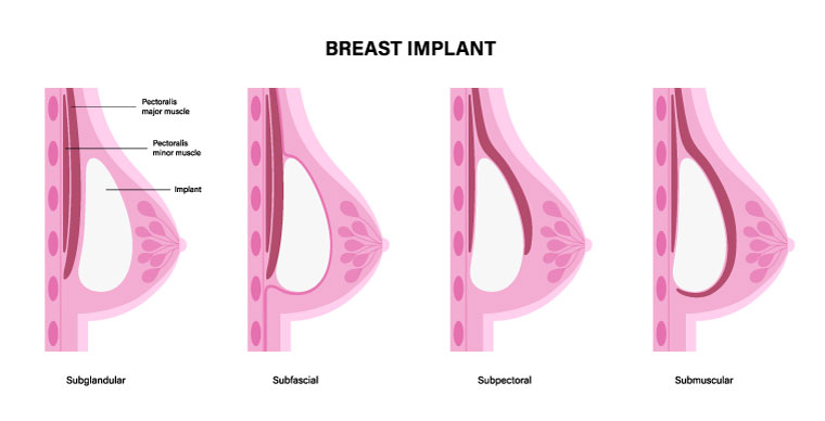 Right Kind Position For Your Implants - Breast & Body Clinic