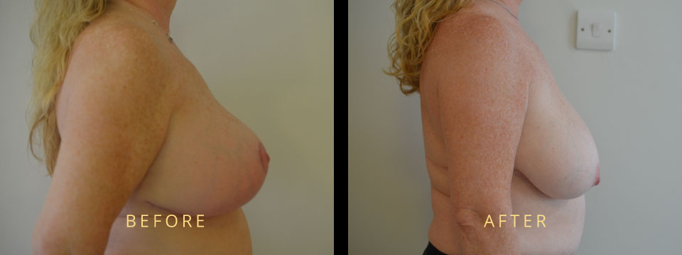breast lift mastopexy before after