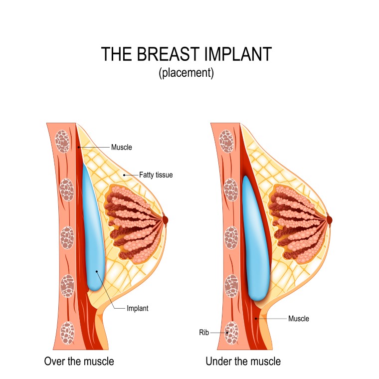 Over the muscle breast implant placement - Breast & Body Clinic