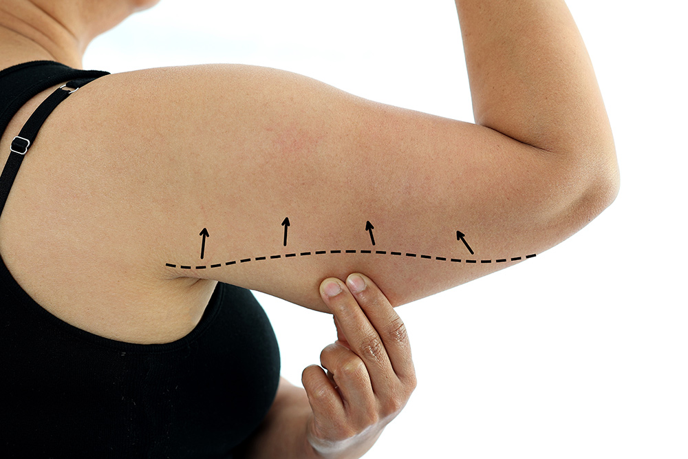 Is Arm Liposuction Worth It | Arm Liposuction Recovery | Is Arm Liposuction Safe