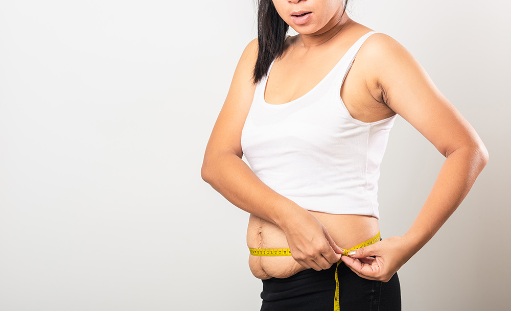 How to Tighten Loose Skin After Weight Loss