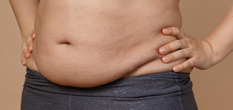 How to Get Rid of Apron Belly | What is Apron Belly | Apron Belly