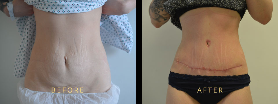 Hourglass Tummy Tuck | What is an Hourglass Tummy Tuck | Hourglass Tummy Tuck Before and After