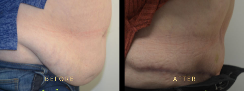 Plus Size Tummy Tuck | Overweight Plus Size Tummy Tuck | Plus Size Tummy Tuck Before and After