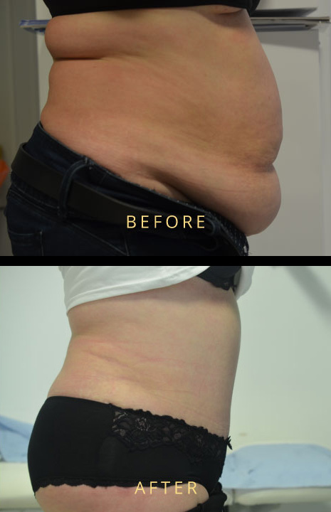 Plus Size Tummy Tuck | Overweight Plus Size Tummy Tuck | Plus Size Tummy Tuck Before and After