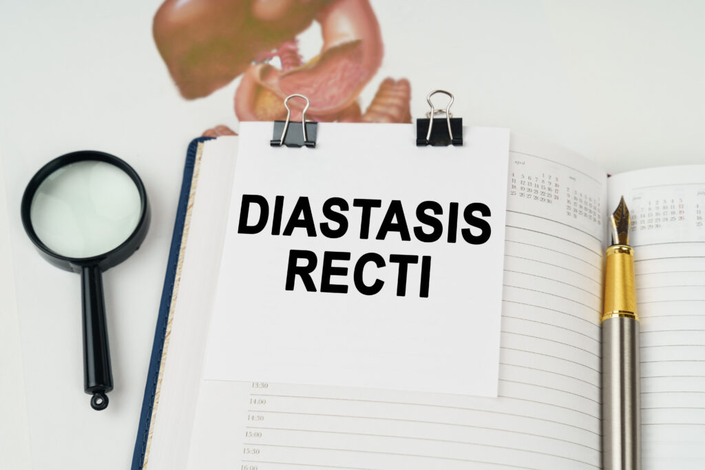 Diastasis Recti Surgery | Diastasis Recti Surgery Scar | Diastasis Recti Surgery Recovery Time