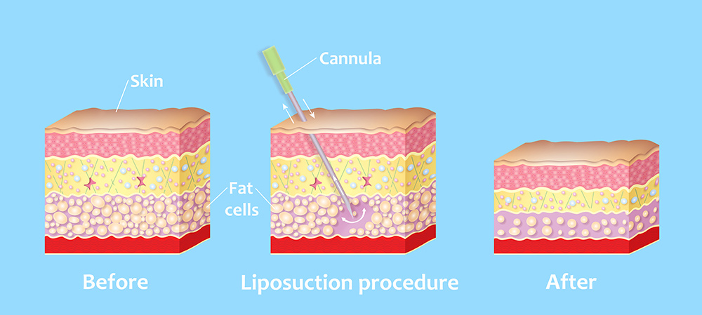 Pros and Cons of Liposuction | Benefits of Liposuction