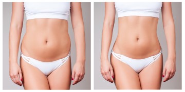 Pros and Cons of Liposuction | Benefits of Liposuction