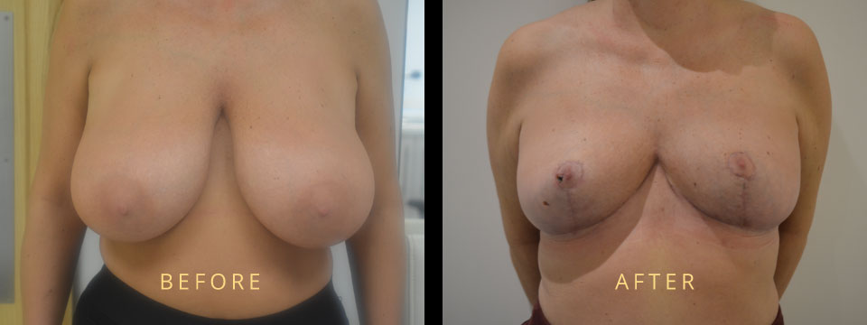 How to Reduce Breast Size | How to Lose Breast Fat | How to Reduce Chest Size