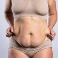 What is an Apron Belly | How to Get Rid of Apron Belly | Exercises for Apron Belly