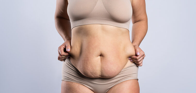 What is an Apron Belly | How to Get Rid of Apron Belly | Exercises for Apron Belly