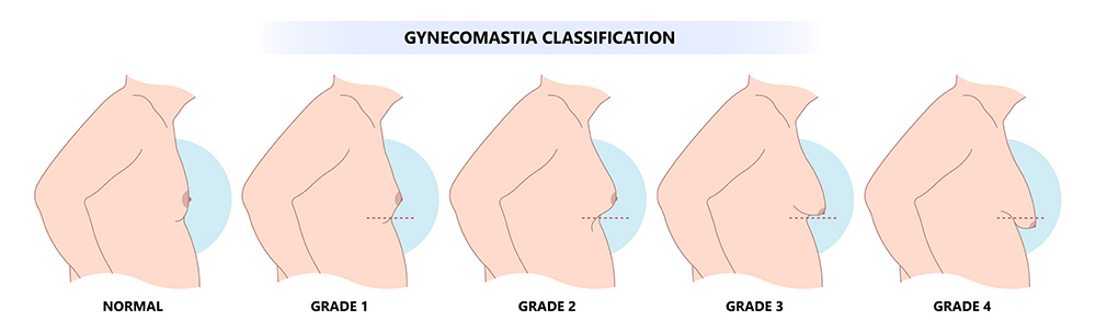 Chest Fat vs Gynaecomastia | How to Lose Chest Fat | How to Tell If You Have Gyno or Just Fat