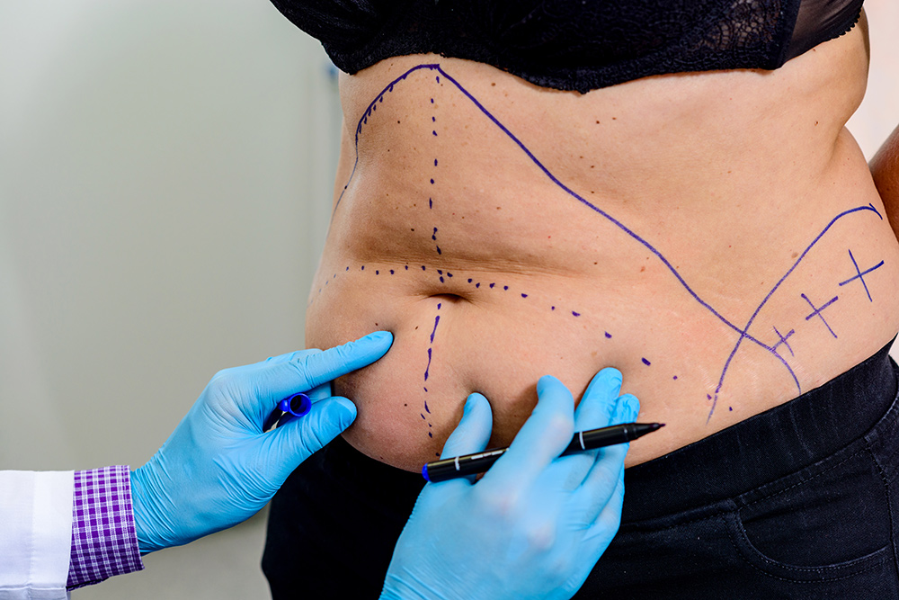 What is an Apron Belly | How to Get Rid of Apron Belly | What Causes Apron Belly