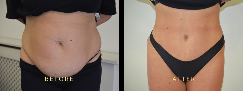 What is an Apron Belly | How to Get Rid of Apron Belly | Apron Belly Types