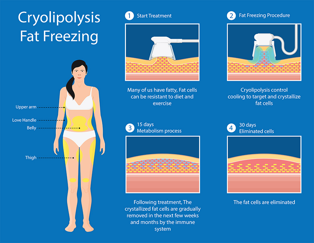 Liposuction vs coolsculpting | Liposuction vs coolsculpting cost