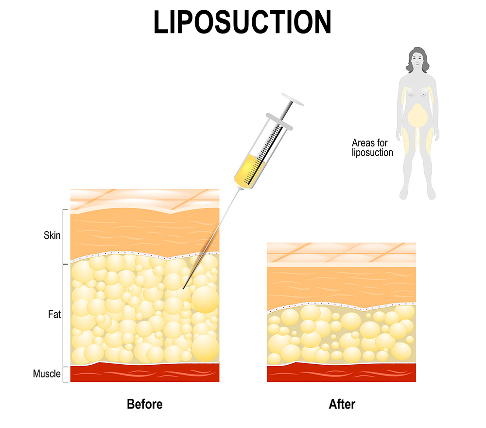 Liposuction vs coolsculpting | Liposuction vs coolsculpting cost