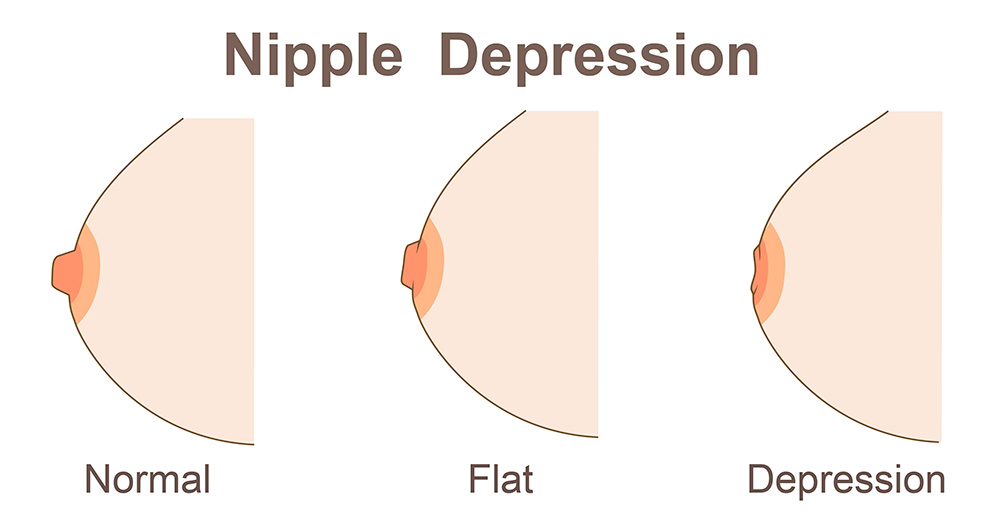 What Causes Flat Nipples and How to Correct Them