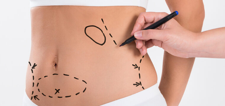 Liposuction | Is Liposuction Safe | Does Liposuction Work | What Does Liposuction Do